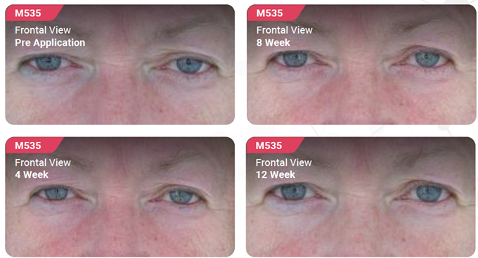 Photos showing the skin's improvement when using Bakuchiol over 12 weeks – front face view.