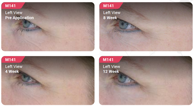 Photos showing the skin's improvement when using Bakuchiol over 12 weeks - left face view.